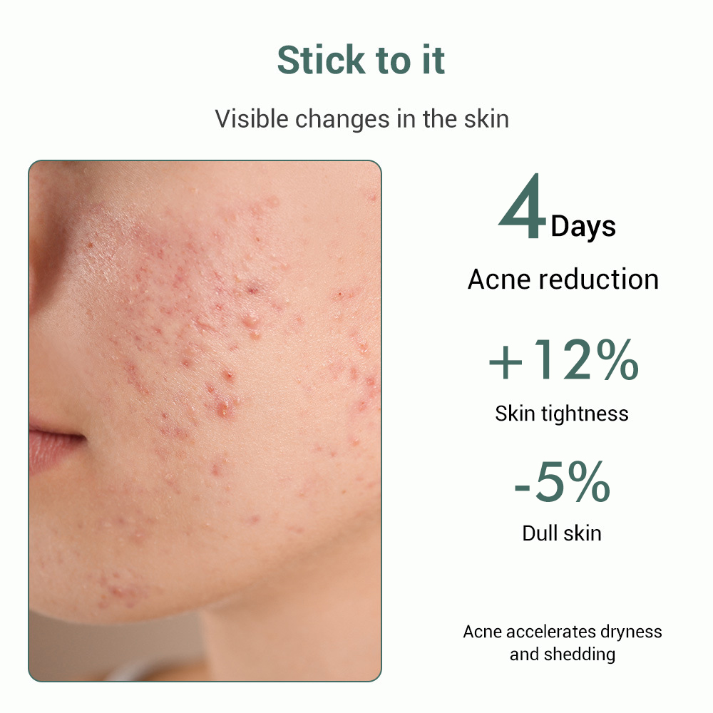 Salicylic Acid Anti-Acne Sheet Mask