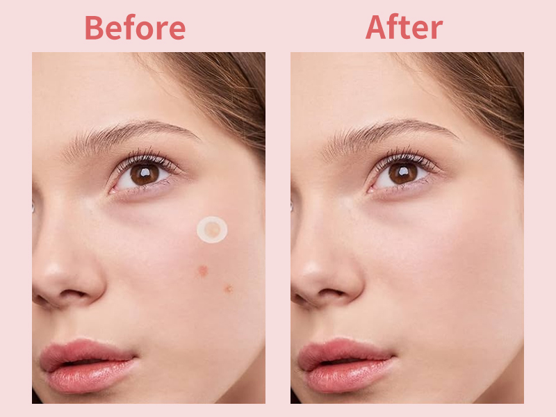 Acne Solution: Salicylic Acid Micro-Needle Pimple Patch